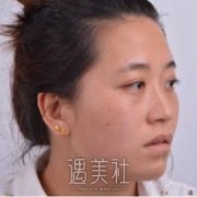 内蒙古呼和浩特京美朱京成做的硅胶隆鼻挺翘、很自然 width=