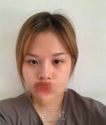 宽到眼眶的双眼皮如何修复？手术相关过程及图片 width=