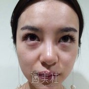 南昌二附院去眼袋案例，真人分享去眼袋手术全过程 width=