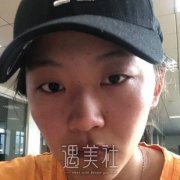 九院王梓双眼皮失败修复案例，重获精致眼眸，美极了 width=