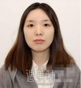 成都垫下巴案例介绍：第一次体会到有下巴的快乐！ width=