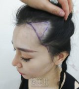 植发后3个月图片，从手术案例看头发种植效果到底如何？ width=