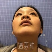 高清鼻子整形案例图片，拥有好看的鼻子特别重要 width=