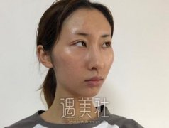 「埋线眼肌矫正+下颌角+颧骨缩小」大变身的美丽小姐姐真人案例分享！ width=