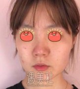 整形日记一览丨摆脱硬朗下颌角，精致更添女人味 width=