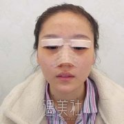 双眼皮修复手术恢复图片，真人案例恢复全过程对比图展示 width=