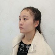 割双眼皮刚做完手术图片，真人双眼皮案例分享 width=