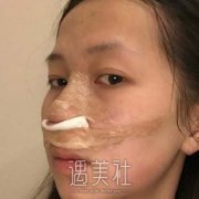 自体软骨隆鼻经历，后悔没有早点做手术，案例分享 width=