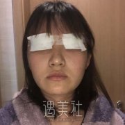 欧式芭比双眼皮图片，真人案例前后对比照片分享 width=