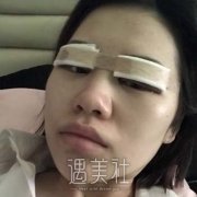 长沙美莱文婷双眼皮案例，技术手法尽在手术恢复图片中 width=