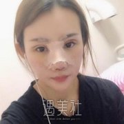 蒜头鼻整形图片案例，手术前后对比展示，拥有精致鼻头 width=
