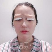 深圳李天石双眼皮案例，不化妆都看起来美美的，自信不少 width=
