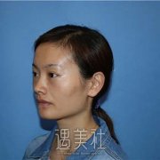 全脸填充一到10天消肿过程图片，真人案例：看得见的年轻 width=