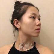 鼻中隔偏曲手术过程图，价格是多少？多久能恢复？ width=