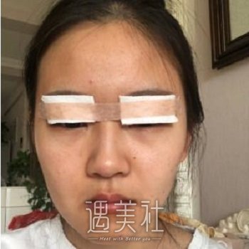 全切双眼皮恢复过程图，真人案例讲述，变身大眼美少女 width=