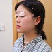 双眼皮恢复一到七天图真实案例，真人记录公开~ width=