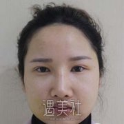 颧骨内推5年后的真实感受，真人案例前后对比图 width=