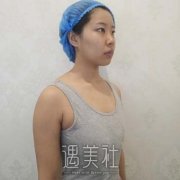 隆胸的图片，假体隆胸案例对比图，恢复全过程差别比较大 width=