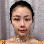 割双眼皮图片恢复图，全切双眼皮一个月效果很惊人 width=