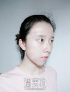 脂肪填充泪沟1-20天恢复图，手术案例分享：少女感满满 width=