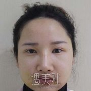 合肥颧骨内推+下颌角磨骨真人案例为你分享 width=