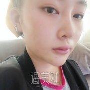 天包地嘴型图片，地包天矫正之后脸型变化特别大