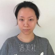 割双眼皮术后1到5天图，真人双眼皮案例对比图 width=