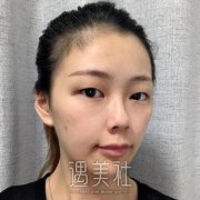 宿州阳光整形医院双眼皮案例，拥有迷人亮眼的方法 width=