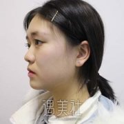 双眼皮手术全切一个月图片，真人案例分享，超惊艳 width=