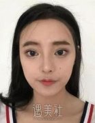 下巴吸脂1到30天恢复图片，真人案例对比照片展示 width=