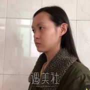 王艳隆鼻案例分析，术后