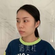 刚做完双眼皮手术照片到