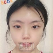 割双眼皮恢复图1-3个月案