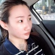 隆鼻手术失败修复照片案